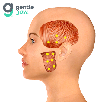 Botox-Injection-Sites-Hirschinger-TMJ.png