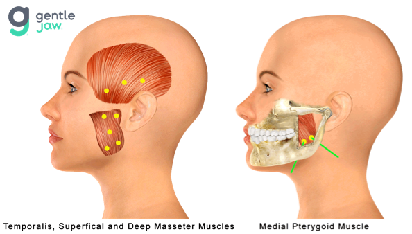 Botox-Injection-Sites-Hirschinger-TMJ-Temporalis-Masseter-Medial-Pterygoid.png
