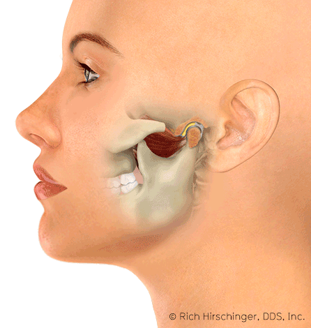 Jaw Dislocation