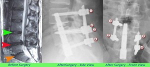 The left side shows the herniation of L4-L5, and the collapse of L5-S1. The middle and right images are the spinal fusion screws. 