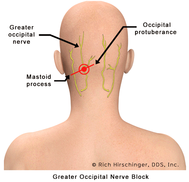 gabapentin nerve pain occipital neuralgia