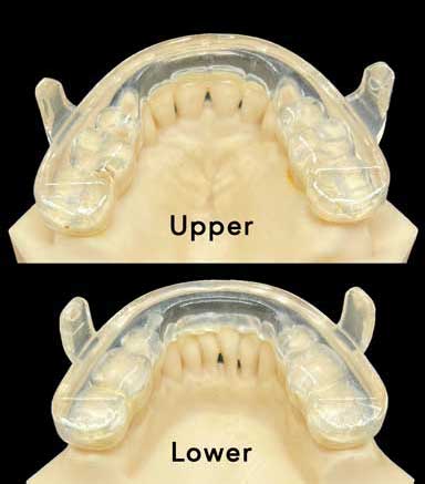 Prosomnus-Max-Mand-Lingual-View.jpg