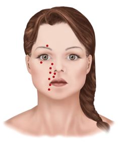 ofp-neuralgia-distribution-spots.jpg