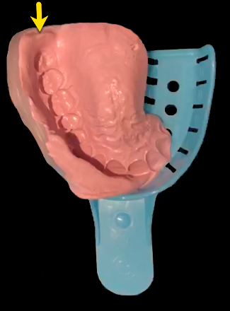 Neurosensory-Stent-Impression.png