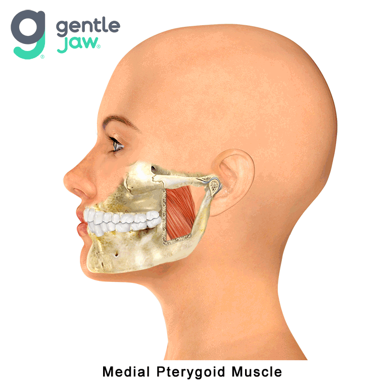 Muscle-Referral-Patterns-Medial-Pterygoid.gif
