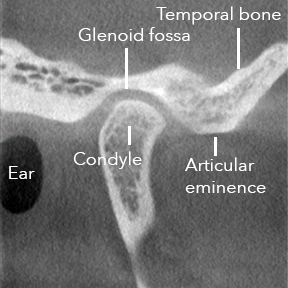 TMJ-normal-lateral.png