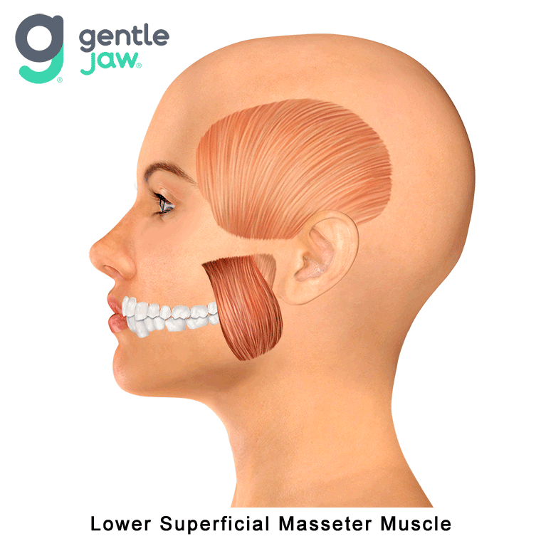 Muscle-Referral-Patterns-Superficial-Masseter-Lower.gif