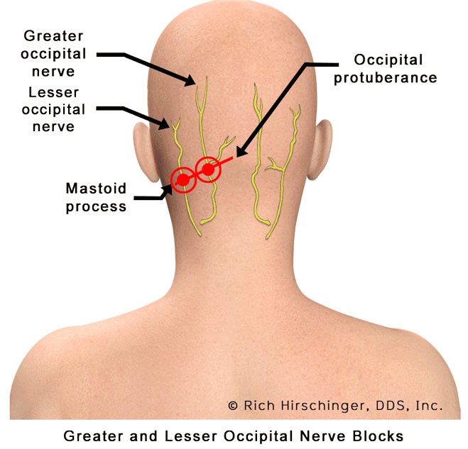 Occipital-Nerve-Blocks-Both.gif