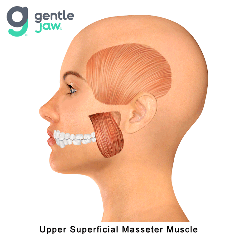 Muscle-Referral-Patterns-Superficial-Masseter-Upper.gif