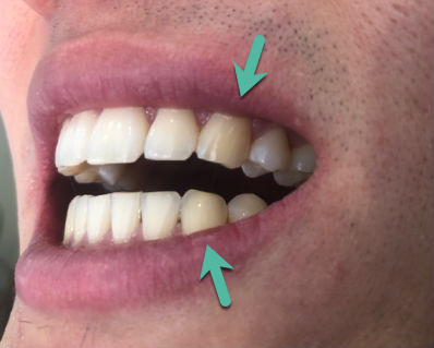 Bruxism-Hirschinger-TMJ-Beverly-Hills.png