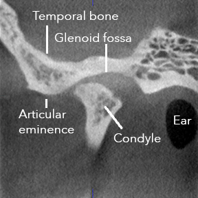 TMJ-abnormal-lateral.png