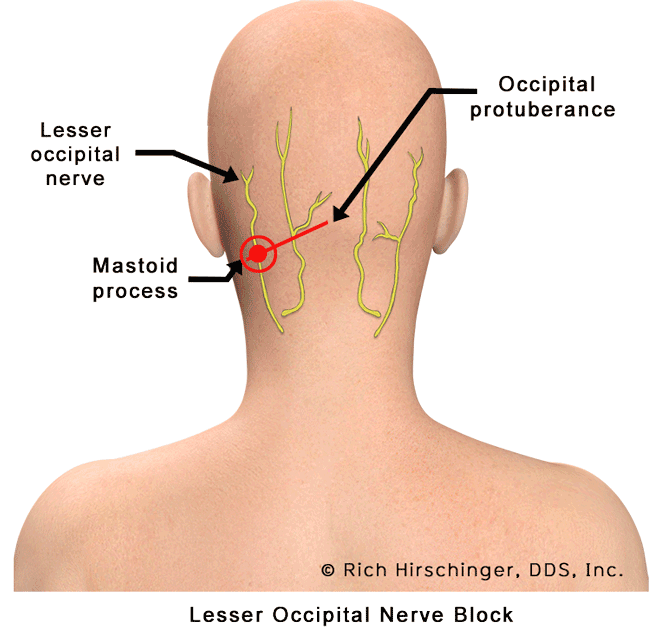 Occipital-Nerve-Blocks-LON.gif