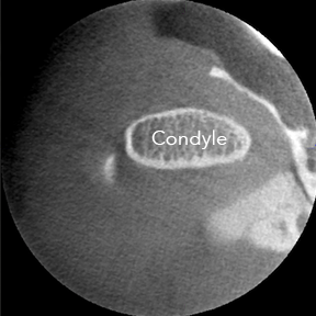 TMJ-normal-axial.png