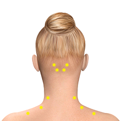 Hirschinger-Migraine-Botox-Injection-Sites-Cervical-Paraspinals-Trapezius.png