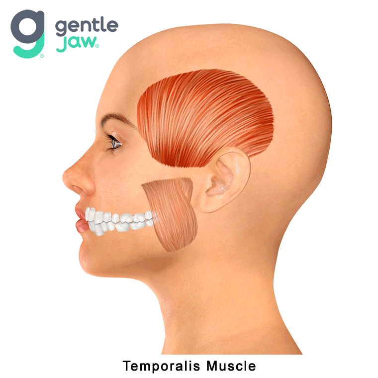 Muscle-Referral-Patterns-Temporalis.gif