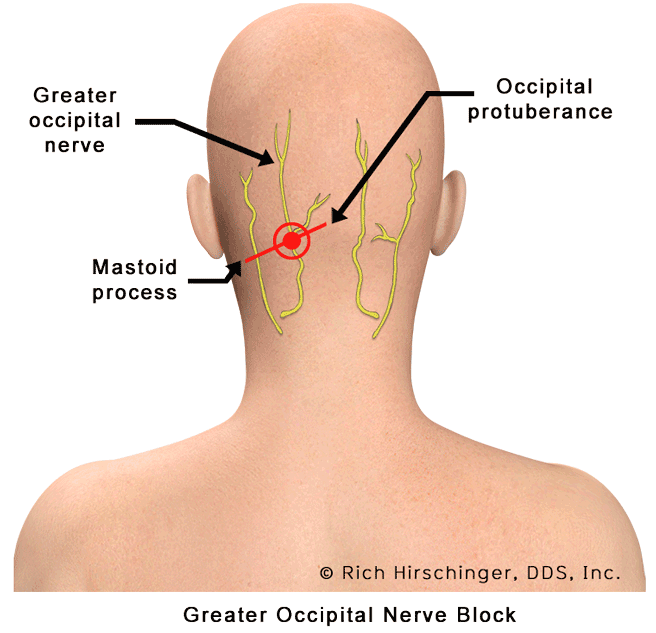 Occipital-Nerve-Blocks-GON.gif